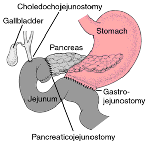 Best pancreatic Surgeon Delhi NCR | Dr. Sanjay Verma