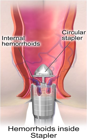 Best Hemorrhoids Surgeon in Delhi NCR | Dr. Sanjay Verma