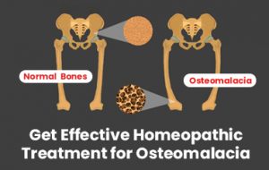 Get an Effective Way to Treat Osteomalacia With Homeopathy